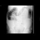 Ileus, large bowel: X-ray - Plain radiograph